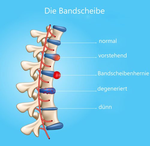 Bandscheiben-degeneration-Neurologe-Piatti-Wien