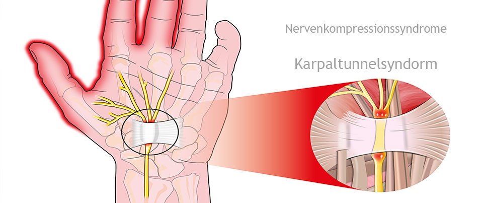 Туннельный синдром врачи. Туннельный синдром карпальный канал. Туннельный синдром запястья. Болезнь де Кервена лучезапястного сустава.